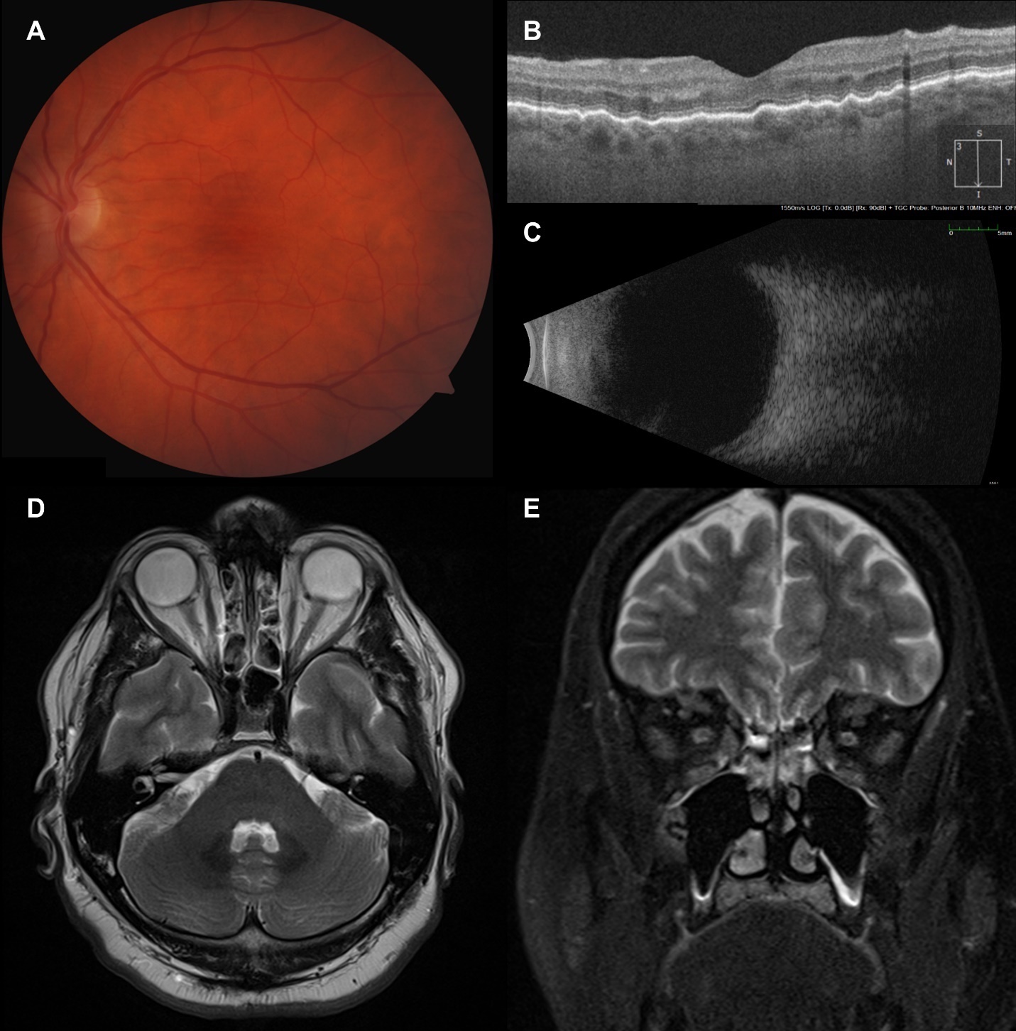 A Case Series Of Chorioretinal And Choroidal Folds Published In