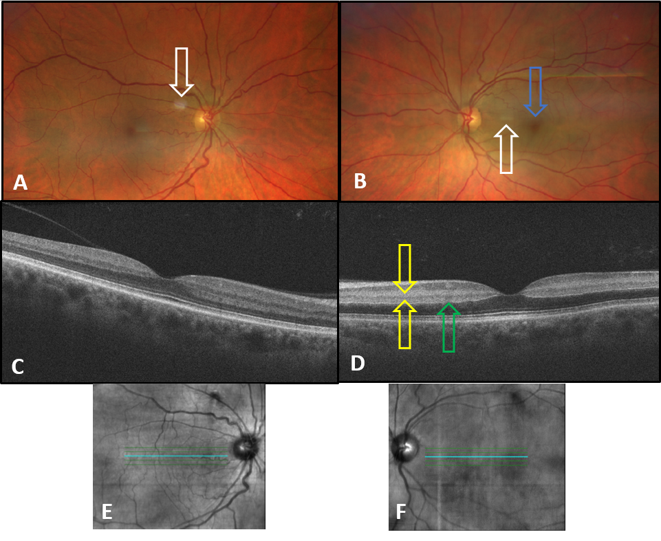 Case Report: Retinal Artery Occlusion Associated with Patent Foramen ...